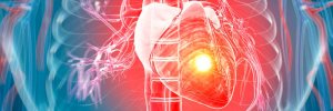 ¿Qué está generando los infartos en Colombia?